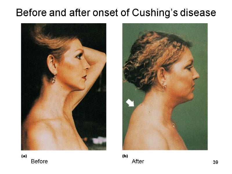 39 Before and after onset of Cushing’s disease After Before